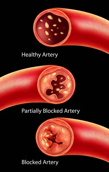 Ateroskleroz anatomisi atardamarda