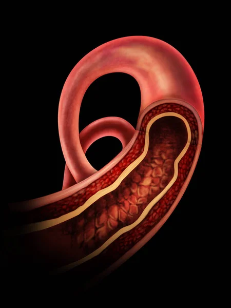 Anatomia miażdżycy tętnic — Zdjęcie stockowe