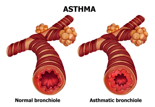 人間の喘息のイラスト — ストック写真