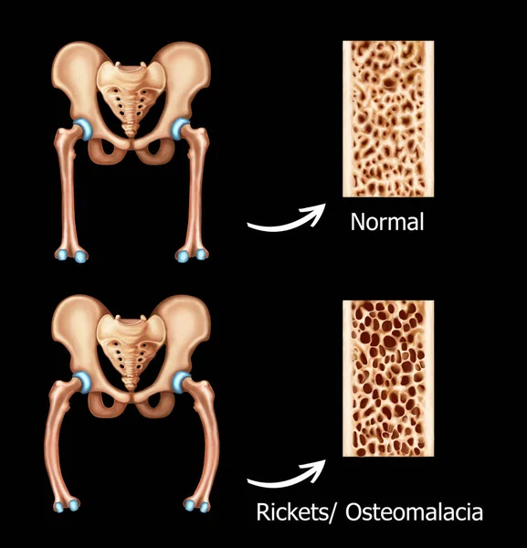 Ilustración Las Rickets Osteopáticas Humanas — Foto de Stock