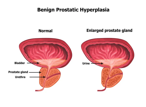 Ilustrace Lidské Benigní Prostaticko Hyperplazie — Stock fotografie