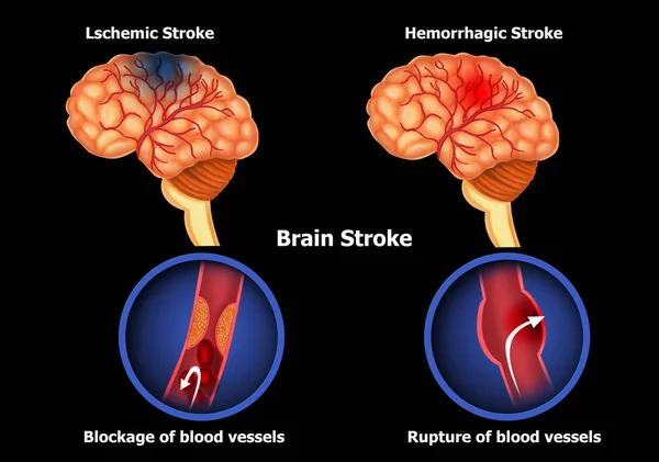 Ilustração Acidente Vascular Cerebral Humano — Fotografia de Stock