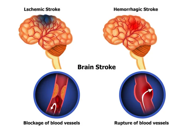 Illustration Human Brain Stroke — Stock Photo, Image