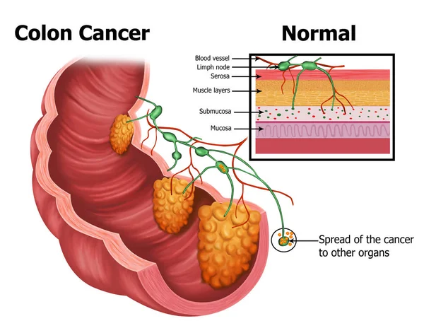 Ilustración Del Cáncer Colon Humano — Foto de Stock