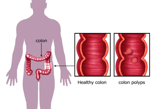 Ilustración Los Colopólipos Humanos — Foto de Stock