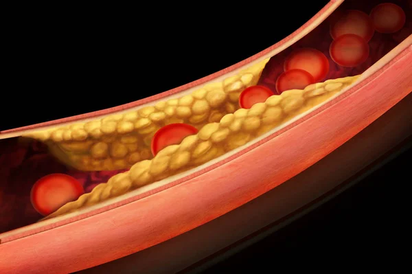 Ateroskleroz anatomisi atardamarda — Stok fotoğraf