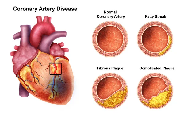 Ilustración Enfermedad Las Arterias Coronarias Humanas —  Fotos de Stock