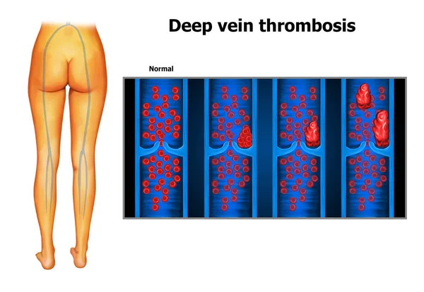 Ilustrace Lidské Hluboké Žilní Trombózy — Stock fotografie