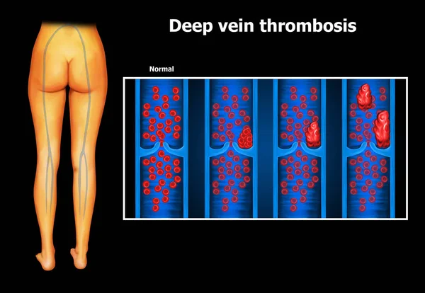 Ilustrace Lidské Hluboké Žilní Trombózy — Stock fotografie