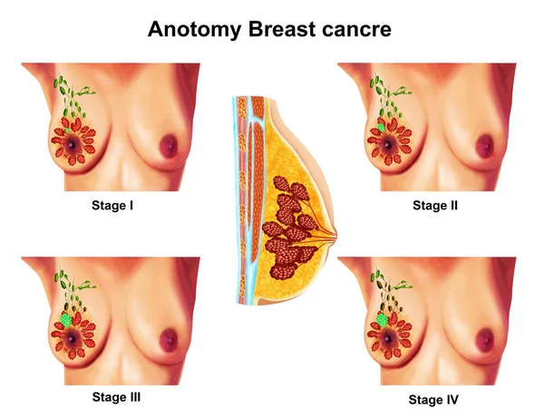 Ilustração Anatomia Câncer Mama — Fotografia de Stock
