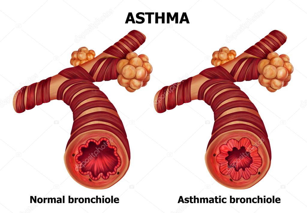 Illustration of human  Asthma