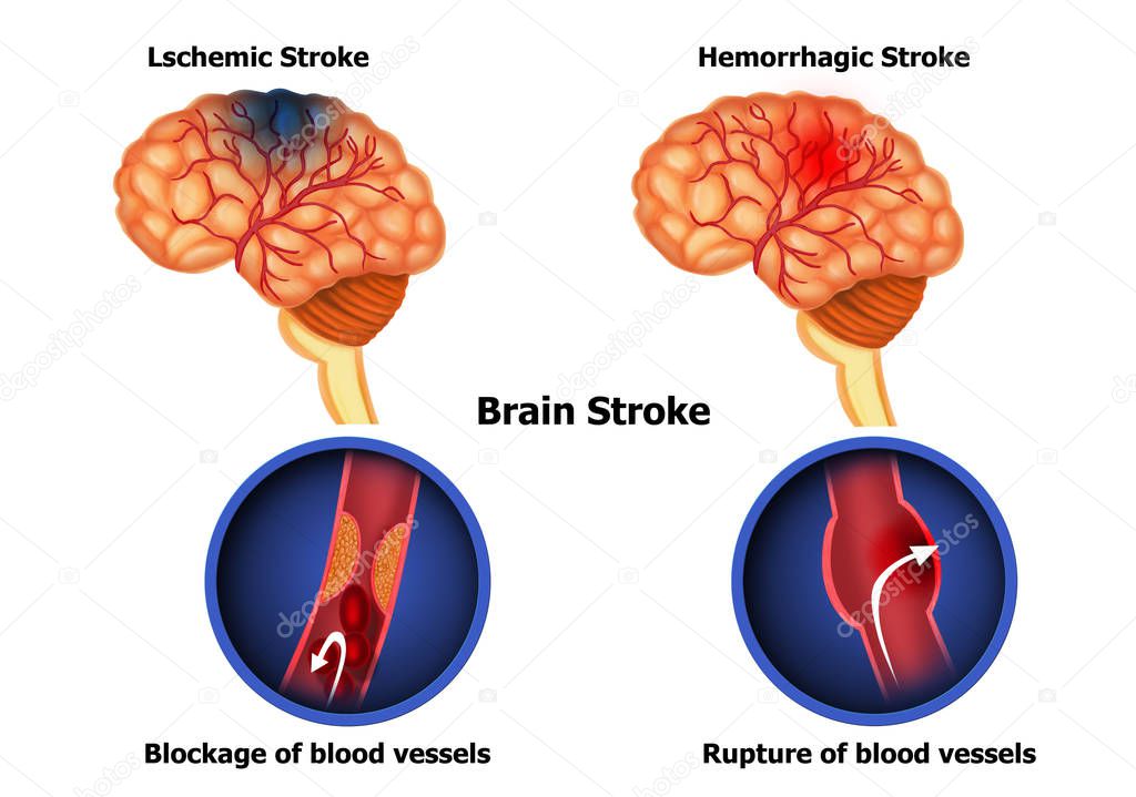 Illustration of human Brain stroke