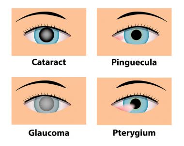 Cataract, Pinguecula, Glaucoma and Pterygium, eye care clipart