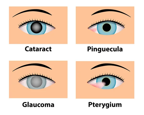 Szürkehályog, Pinguecula, zöldhályog és a Pterygium, szemészet — Stock Vector