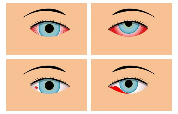 Zánět spojivek a červenou krví podlité oči, vektorové — Stockový vektor