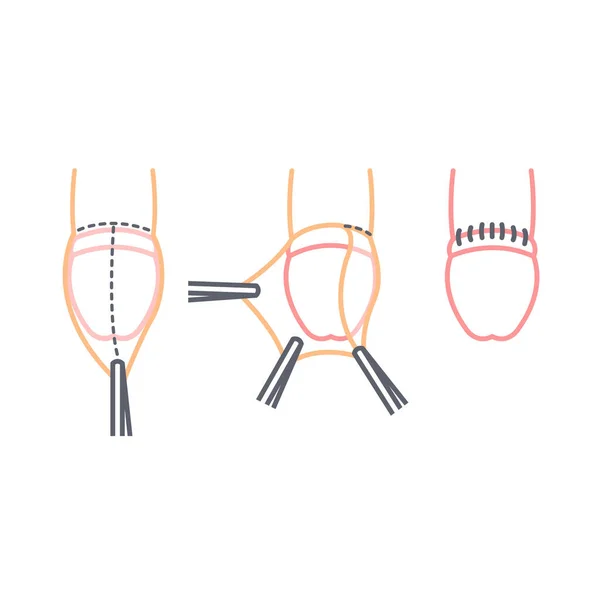 Circumcision Line Icon Vector Simple Illustration — Stock Vector