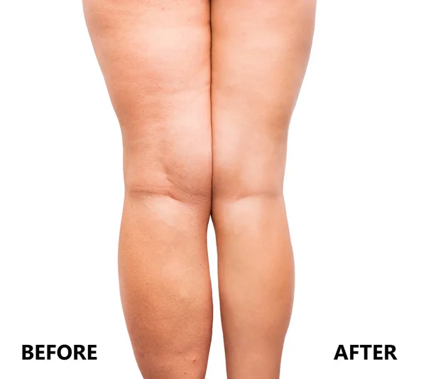 Ženské nohy před a po zhubnutí — Stock fotografie