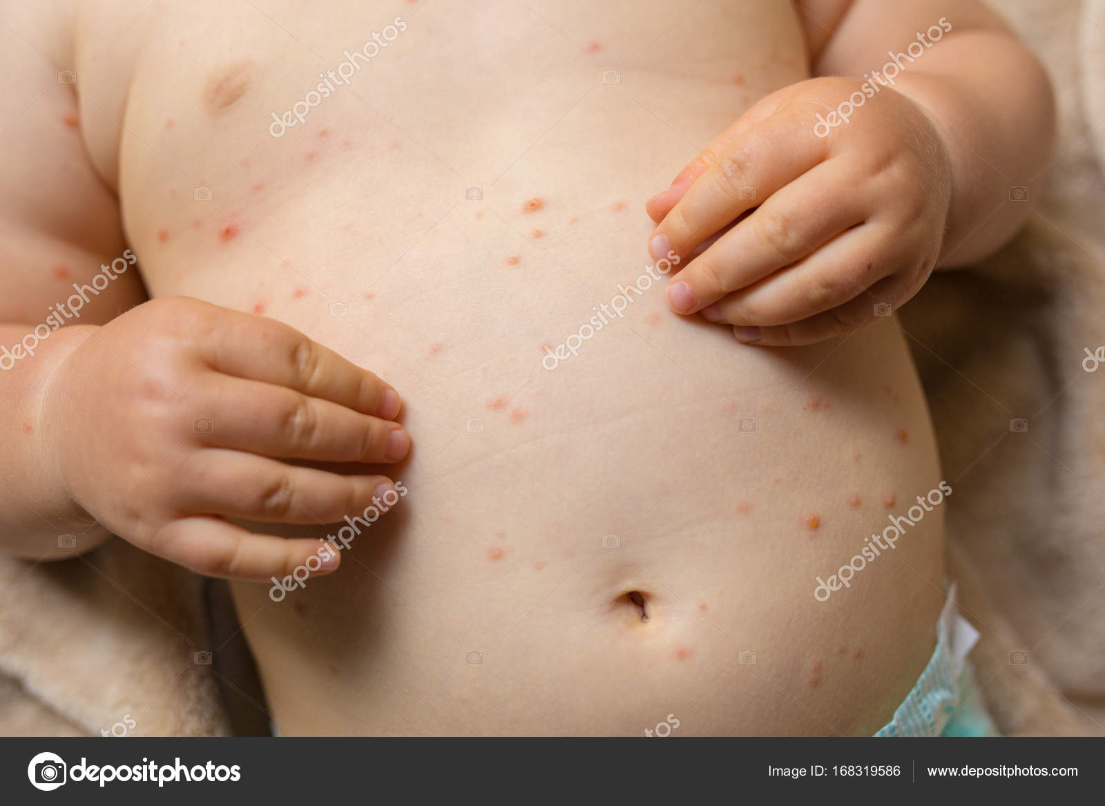 baby heeft rode vlekjes baby heeft rode vlekjes