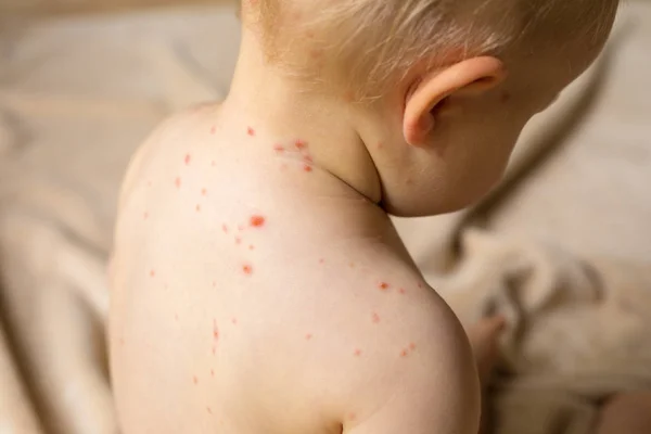 Measles Stock Photos Royalty Free Measles Images Depositphotos