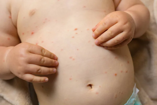 Dítě s červenými skvrnami planých neštovic — Stock fotografie