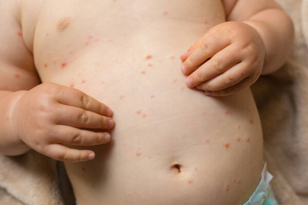 Baby with red spots of chickenpox