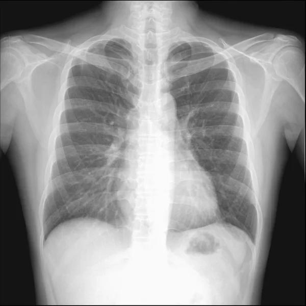 Pneumothorax seen in chest radiography which want to intercostra — Stock Photo, Image