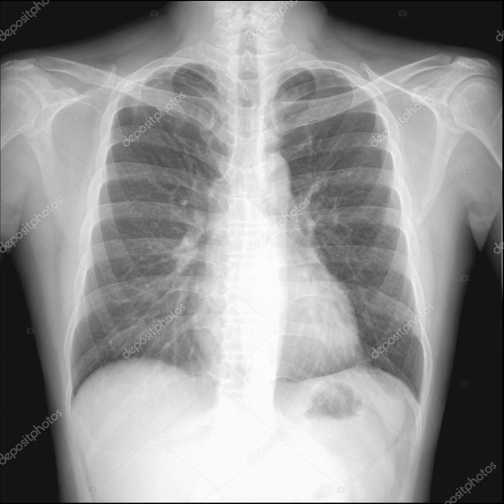 pneumothorax seen in chest radiography which want to intercostra
