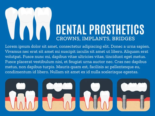 Ilustração de próteses dentárias —  Vetores de Stock