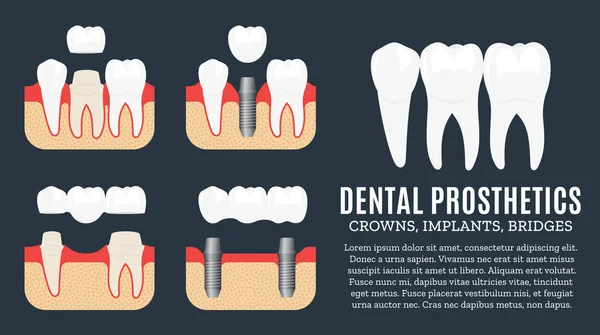 Иллюстрация протезирования зубов — стоковый вектор