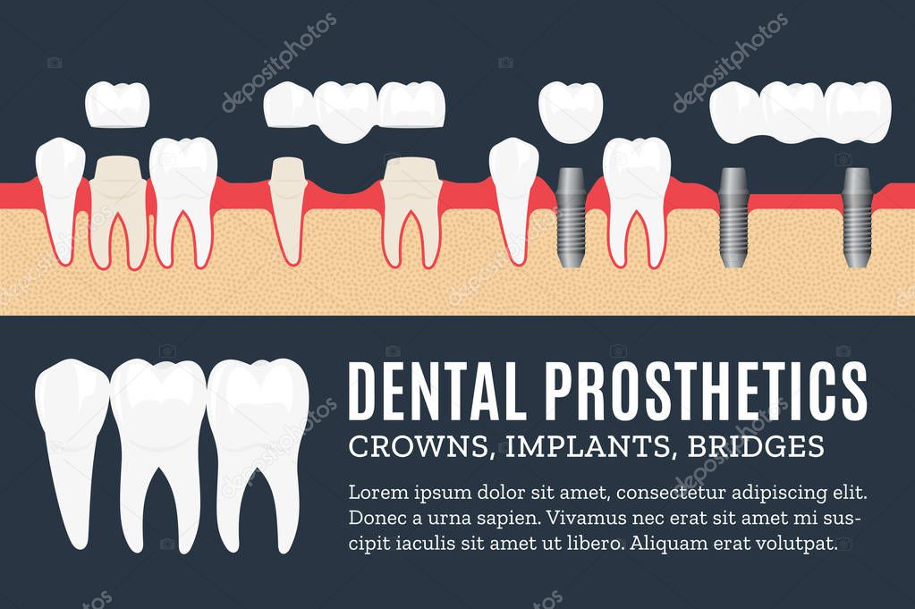 Dental prosthetics illustrartion