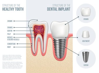 Gerçekçi sağlıklı diş ve diş implant