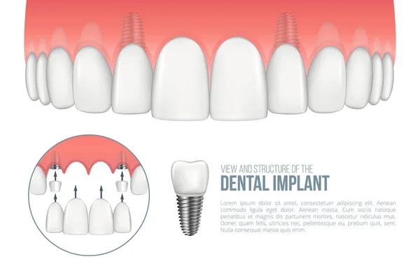 Reális egészséges fogak és fogászati implantátum — Stock Vector