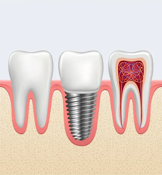 Diente sano realista e implante dental — Archivo Imágenes Vectoriales