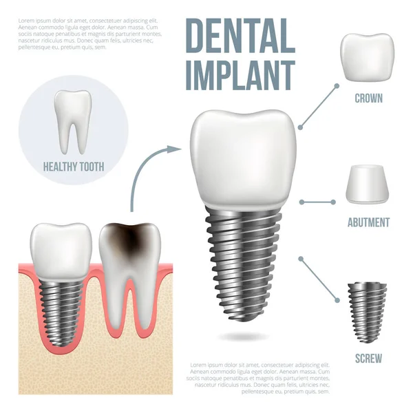 Gerçekçi sağlıklı diş ve diş implant
