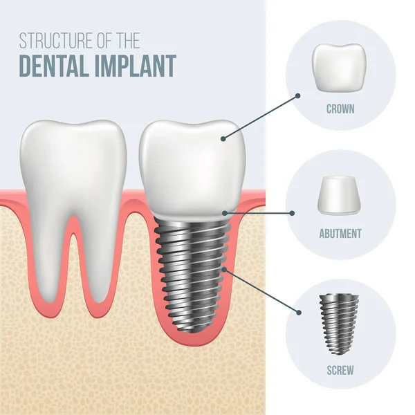 Diente sano realista e implante dental — Vector de stock