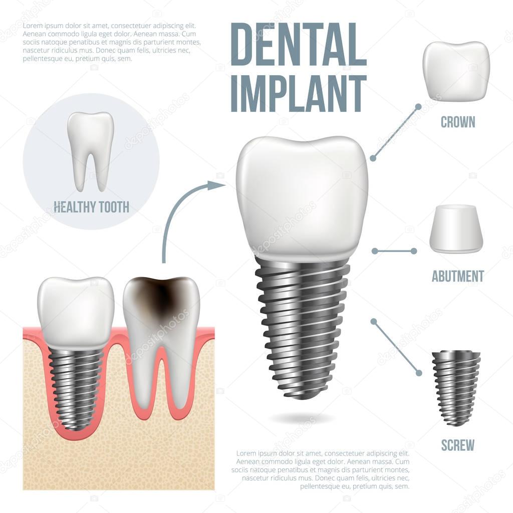 Realistic healthy tooth and dental implant