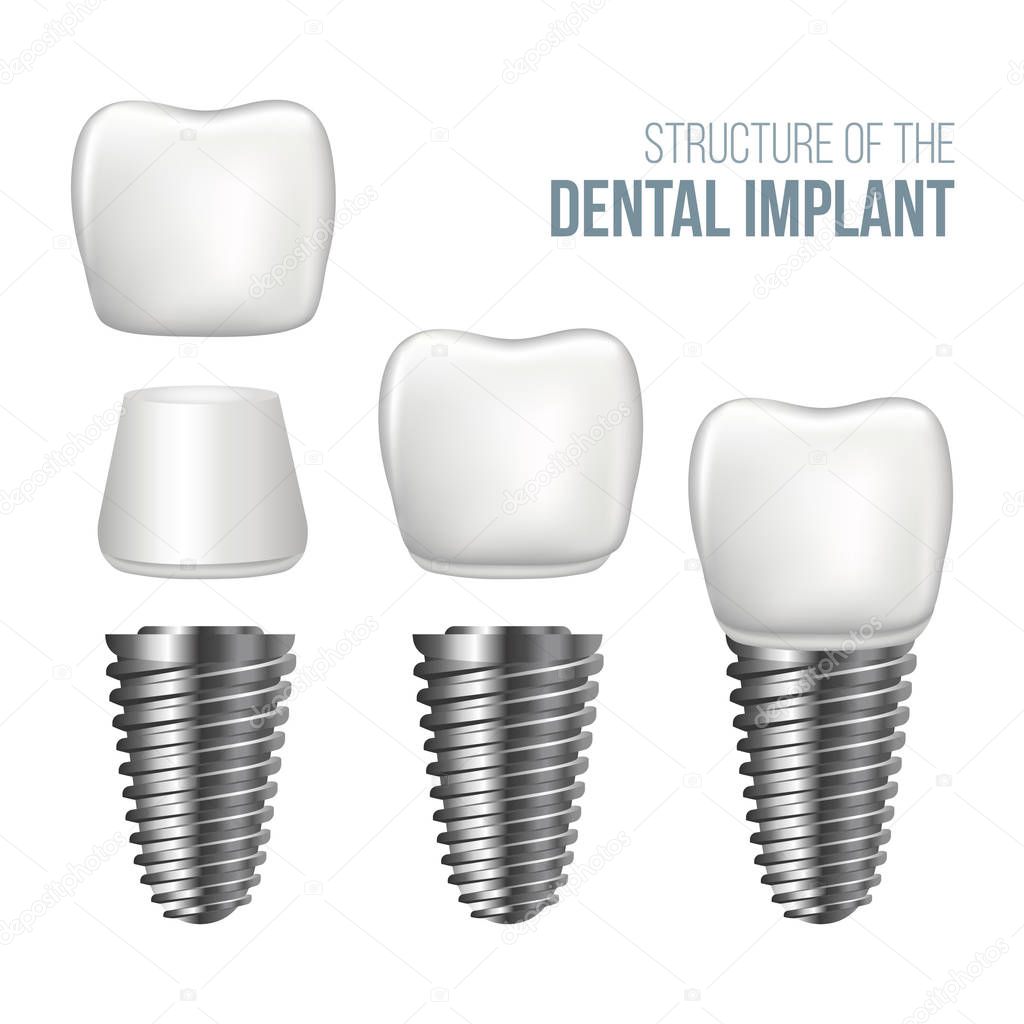 Realistic healthy tooth and dental implant