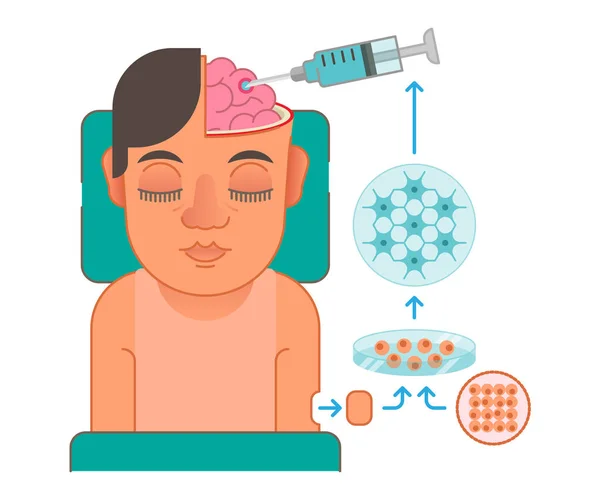 Ilustração do conceito de transplante de células cerebrais —  Vetores de Stock