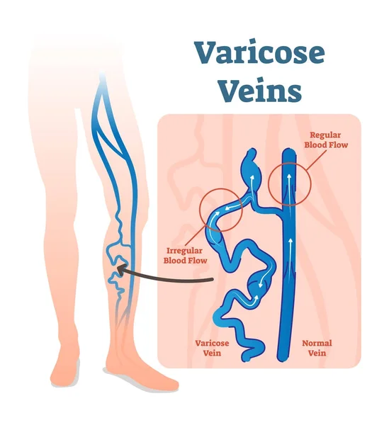 Vene varicose con flusso sanguigno irregolare e schema di illustrazione vettoriale delle vene sane . — Vettoriale Stock