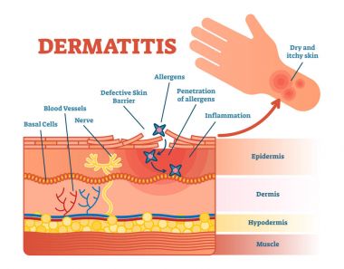 Dermatit düz vektör çizim diyagramı 