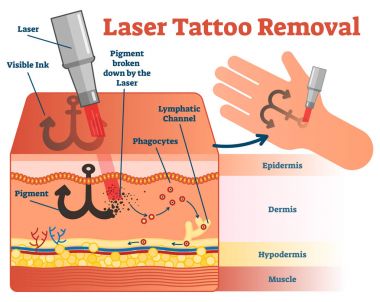 Lazer dövme kaldırma vektör çizim diyagramı. 
