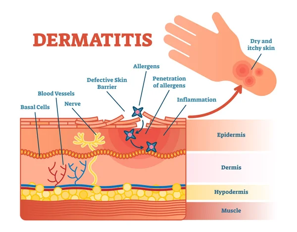 Dermatitis vector plano diagrama de ilustración — Vector de stock