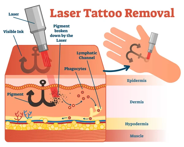 Lézeres tetoválás eltávolítás vektoros illusztráció diagram. — Stock Vector