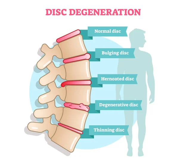 Disc degeneration flat illustration vector diagram — Stock Illustration Disc degeneration flat illustration vector diagram Stock Illustration