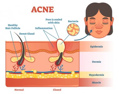 Acne vector diagram illustration  clipart