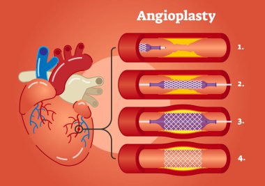 Anjiyoplasti vektör çizim diyagramı