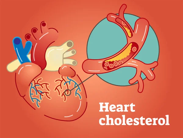 Herzcholesterinkonzept — Stockvektor