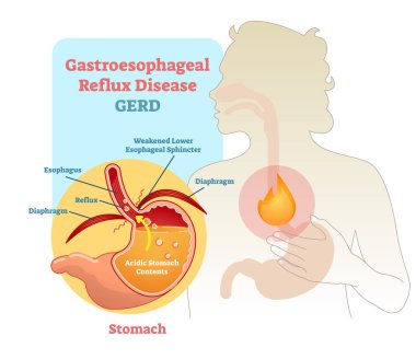 Gastroesophageal Reflux disease diagram scheme clipart