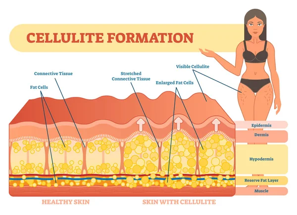 Diagrama da ilustração do vetor da formação da celulite, esquema de informação médica . —  Vetores de Stock