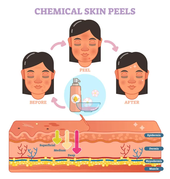 Piel química peels vector ilustración diagrama — Archivo Imágenes Vectoriales